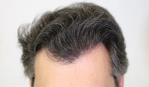 Después del injerto capilar